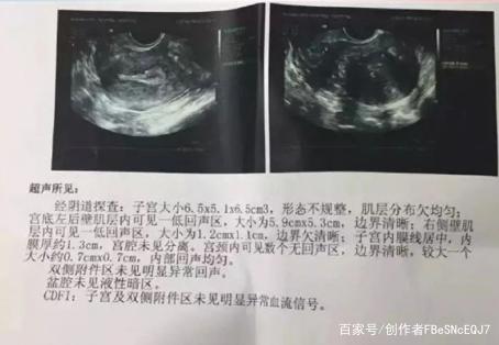 石家庄港大妇女儿童医院：30出头就被查出子宫肌瘤，我该怎么办？