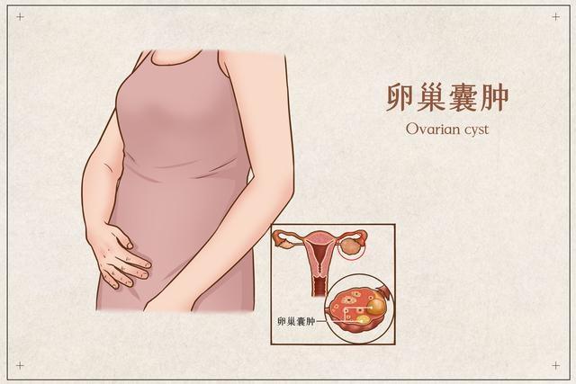 遇上卵巢囊肿，还能怀孕吗？