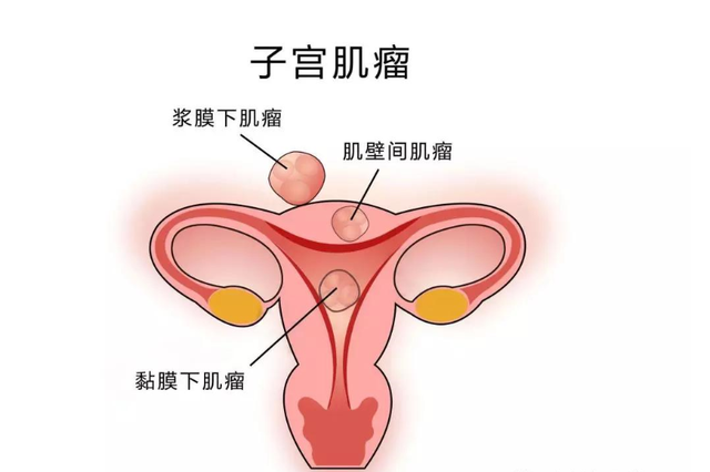 女性容易长子宫肌瘤的原因有哪些？医生提醒尽量远离这3个行为