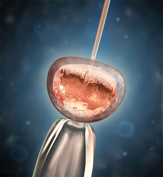 做试管怎么看移植囊胚还是普通胚？试管移植后的注意事项