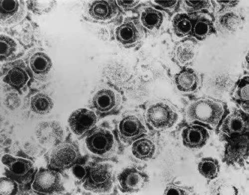 单纯疱疹病毒和神经退行性疾病之间可能存在联系的证据